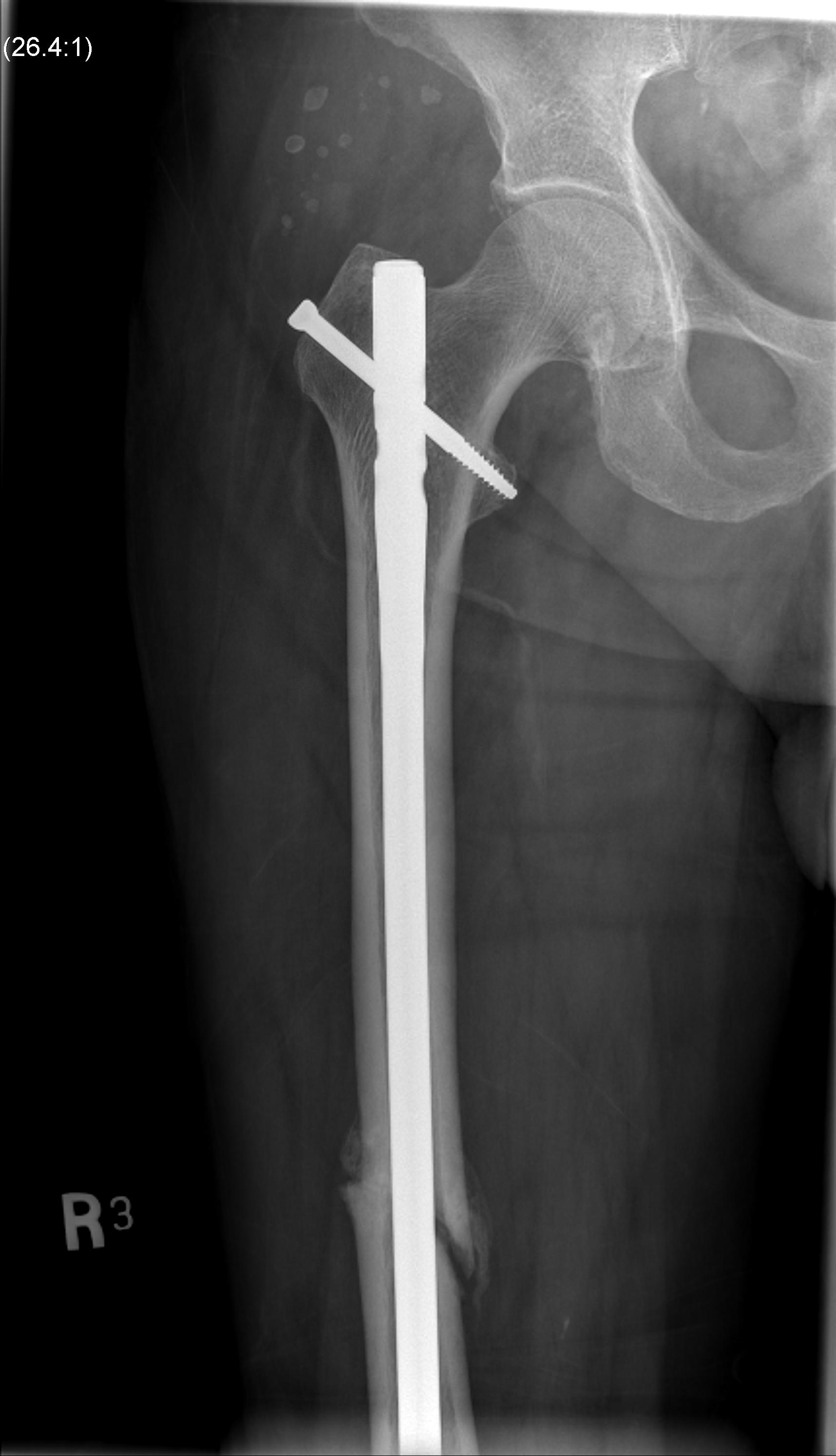 Femoral Nail0001